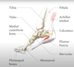 plantar fasciitis